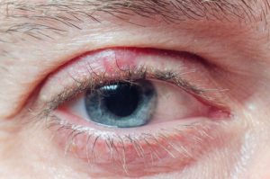 Ögoninflammation hos barn